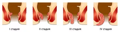 gemorroidalnyj-tromboz-stadii