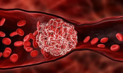 тромбоз артерий картинка