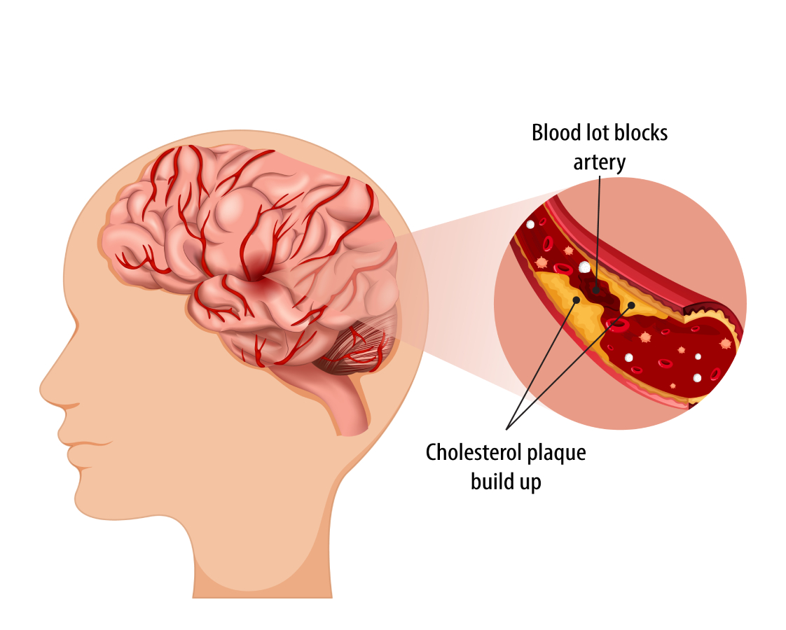 схема образования тромбов в головном мозге